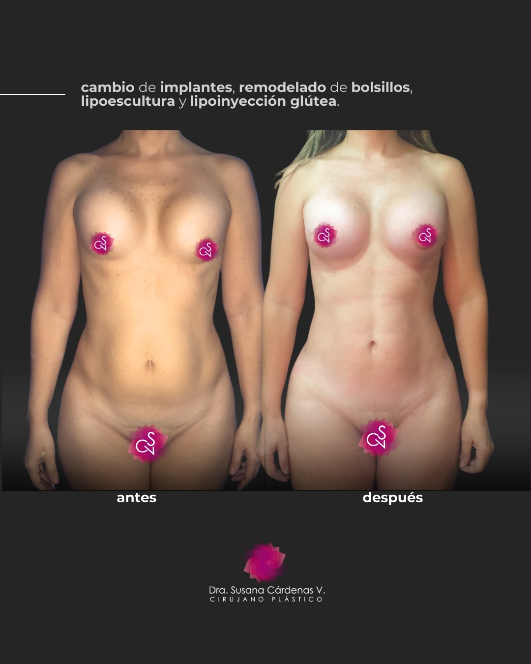 Hablemos con honestidad: el cuerpo cambia, y querer mejorarlo es una decisión de amor propio totalmente válida. En este antes y después, el objetivo era claro: restaurar la firmeza y definir el contorno sin perder la elegancia.
Logramos este cambio combinando procedimientos clave: ✅ Cambio de implantes + Mastopexia periareolar: Para devolver la posición y forma ideal a las mamas. ✅ Lipoescultura abdominal + Lipoinyección glútea: Para eliminar lo que sobra y dar volumen donde hace falta, creando una silueta balanceada.
Un cambio técnico preciso para un resultado que habla por sí solo.
¿Quieres saber más? Déjame un mensaje o un comentario, o visítame en: 📸 @corporeesthetic 📍 Centro Profesional Tamanaco, CCCT, Nivel C1, Consultorios 21 y 22. ☎️ 0212-9595552 📱 0424-2949477