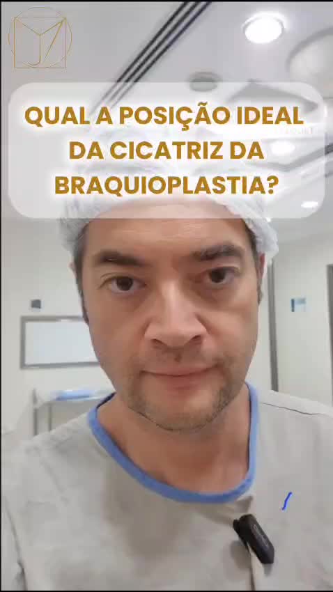Qual a posição ideal da cicatriz da braquioplastia? ?
? Assista ao vídeo para saber a resposta!
Referências científicas comentadas no vídeo:
Positioning the scar of the region brachioplasty upper arm in ex-obese patients
Lima Junior EM, et al. Positioning the scar of the region brachioplasty upper arm in ex-obese patients. Rev. Bras. Cir. Plást. 2013;28:538-543
Dr Juan Montano
Arte e Ciência
#braquioplastia #braquioplastiasp #cirurgiaplasticasp #cirurgiaoplasticomoema #plasticamoema
