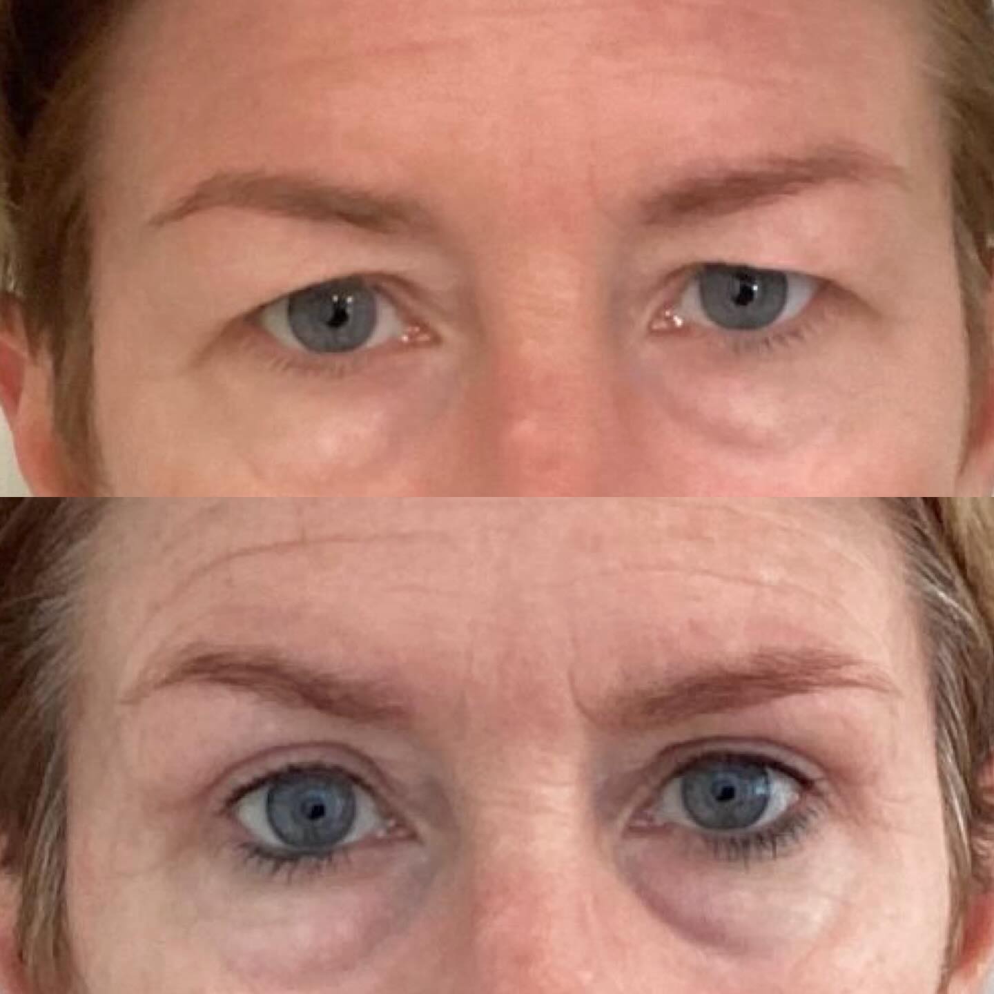 Eyelid surgery ?
1. Improved appearance
It removes excess skin, fat, and sagging around the eyes, making you look more refreshed, youthful, and less tired.
2. Better vision
In some cases, droopy upper eyelids can obstruct your field of vision. Surgery can lift this excess skin and improve how well you see—especially peripheral vision.
3. Boost in confidence
Many people feel more confident and comfortable in their appearance after the procedure, which can positively impact social and professional interactions.
DM us for more info ??
#eyelidsurgery #blepharoplasty #excessskinremoval