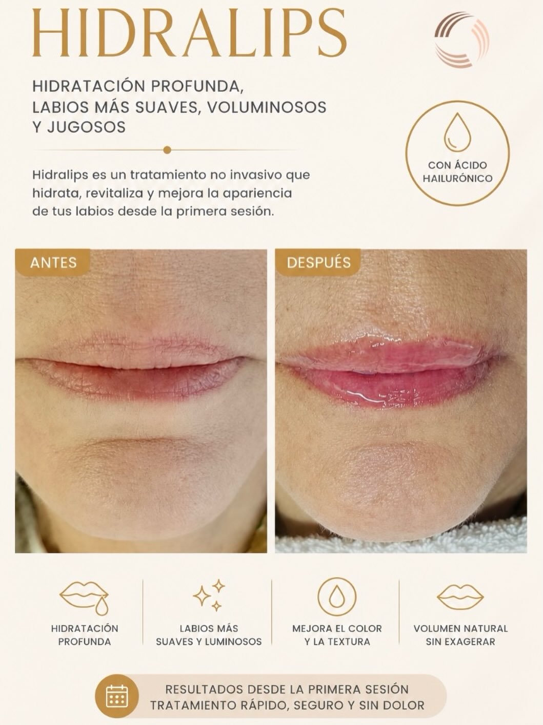 ✨ Labios hidratados, suaves y con un brillo natural ✨
Hidralips es un tratamiento no invasivo con ácido hialurónico que ayuda a hidratar profundamente los labios, mejorar su textura y devolverles un aspecto más brilloso y saludable ?
✔️ Hidratación profunda
✔️ Mejora el color y la textura
✔️ Volumen natural
✔️ Resultados desde la primera sesión
Agenda tu evaluación y luce unos labios más saludables y luminosos ?
#hidralips #dermasanmartin #labioshidratados #skincare