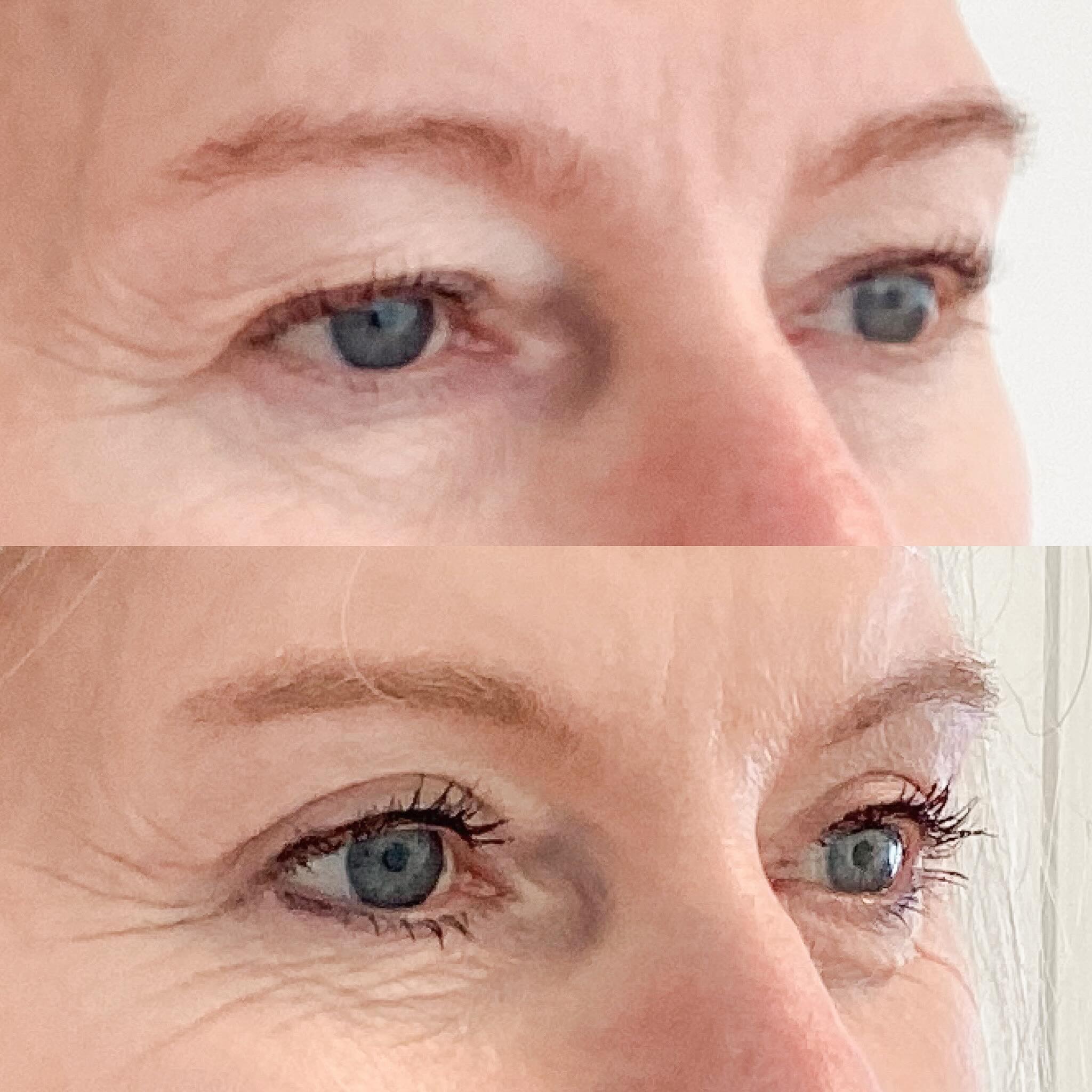 Starting the week with some beautiful before and afters ??
#naturalresults #eyelift #lanluma #lipfiller #nosejob