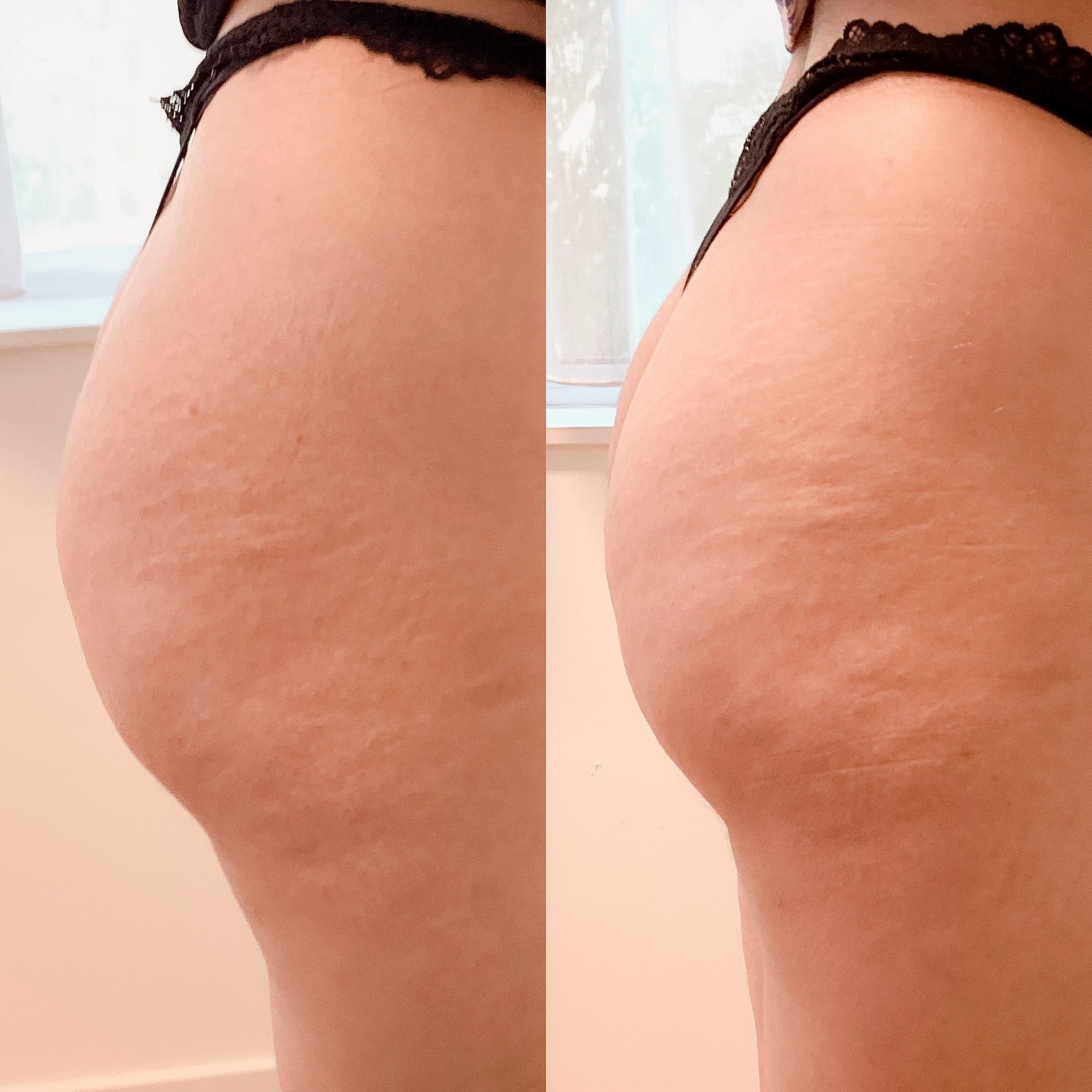 Results after only one Lanluma treatment ❤️
#lanluma #beforeafter #cosmeticclinic #lanlumatreatment